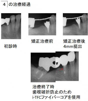 右下小臼歯の治療経過